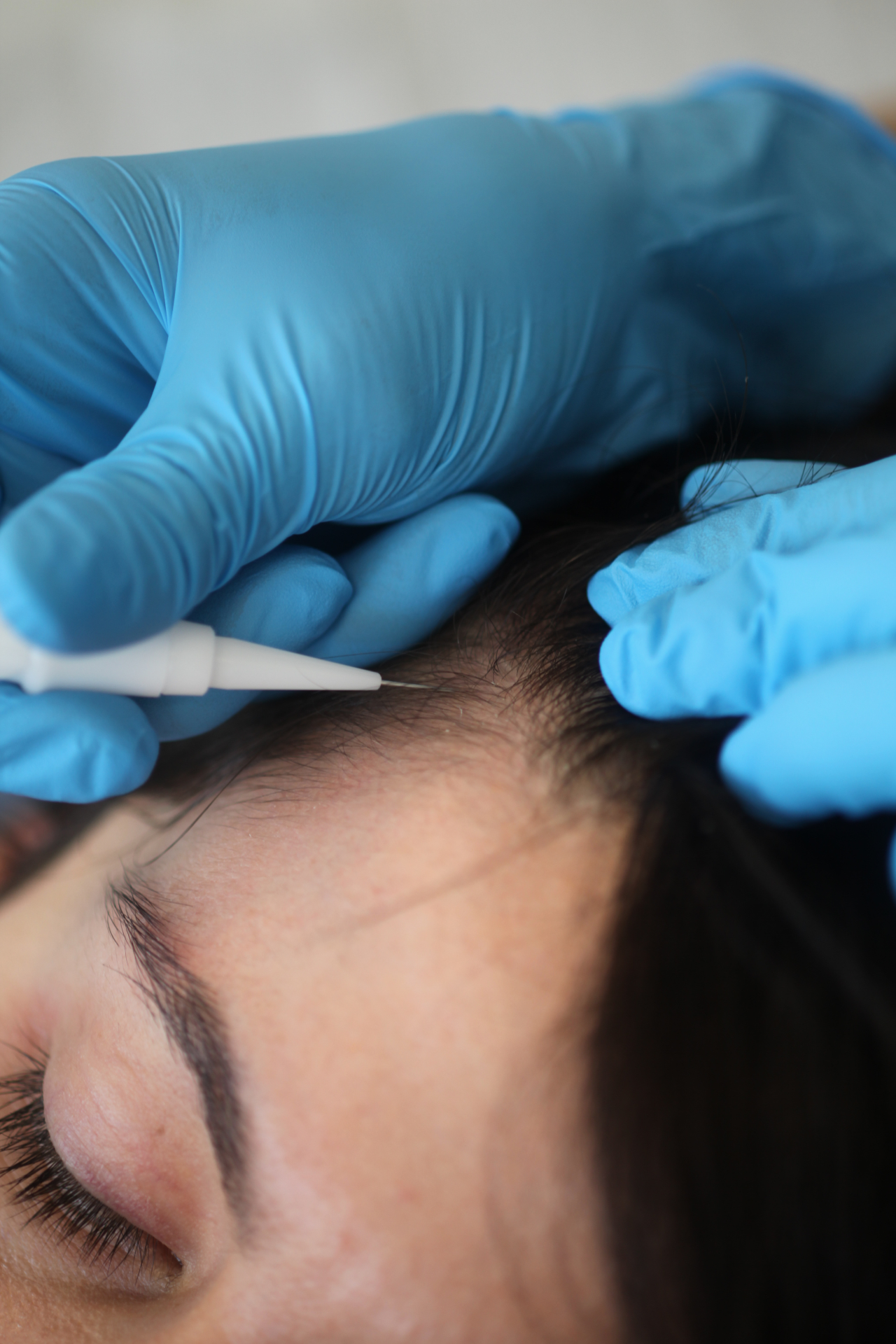 Greffe FUE long hair - implantation NHT
